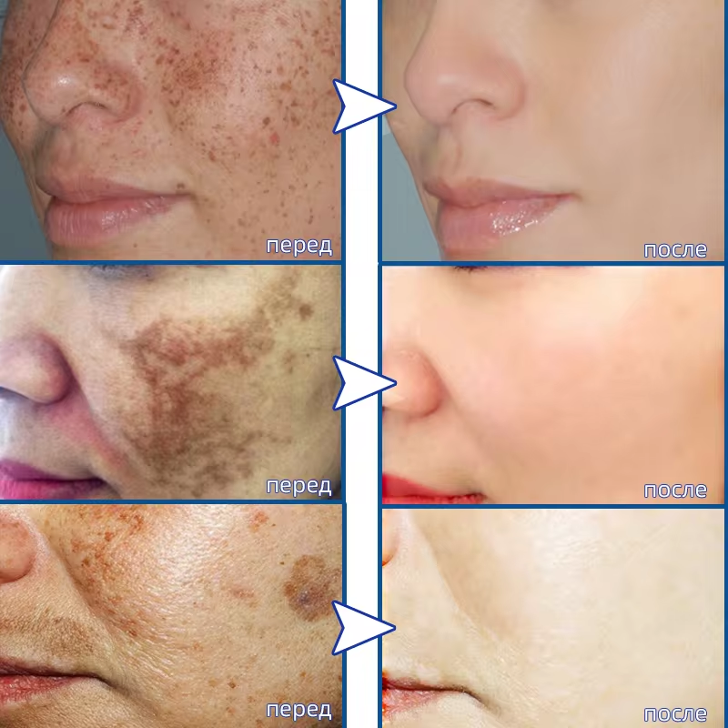 Powerful Spot-removing Whiteni - Vitamin C Serum Face 评论和价格
